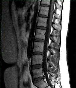 мрт позвоночника